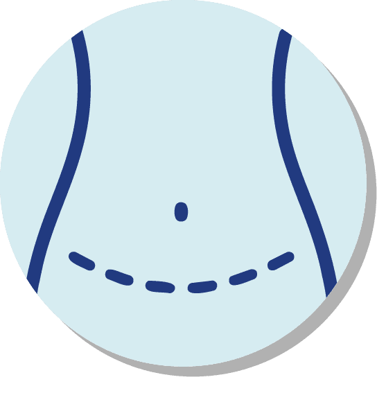 Abdominoplastia
